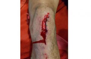 Entrada de Marega deixou joelho de Fejsa assim